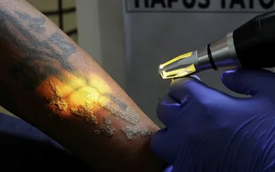 Indonesia authorities provide free tattoo removal services for Muslims
