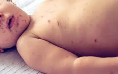 Measles claims lives of five children in Tando Allahyar