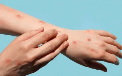 Pharmacist Can Positively Influence Mpox Vaccinations