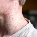 Measles cases surge in Karachi and Sindh