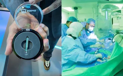 UAE: Matchstick-sized pacemaker requires no surgery, lasts for 25 years