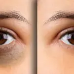 Simple tips for reducing dark circles under the eyes