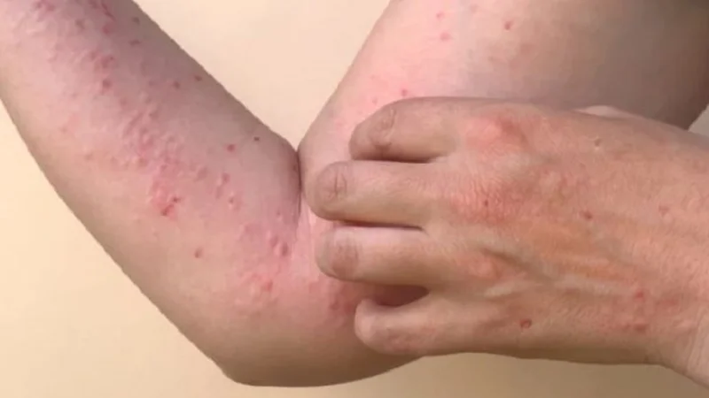 Pakistan confirms its first case of monkeypox of 2024