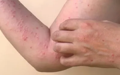Pakistan confirms its first monkeypox case of 2024