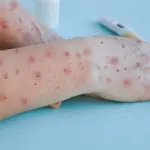 Pakistan reports second case of Monkeypox
