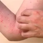 Chikungunya cases rate increase in Karachi