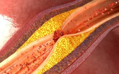 Here's how to reduce fat in arteries
