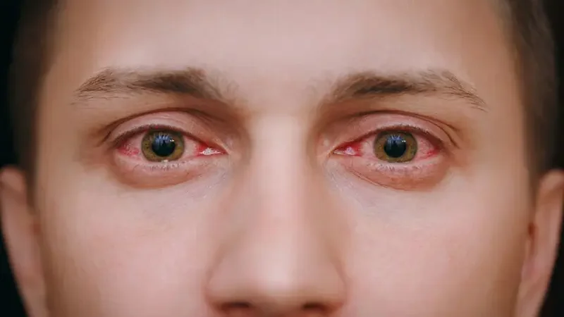 Red Eyes: Experts explain common causes and preventions