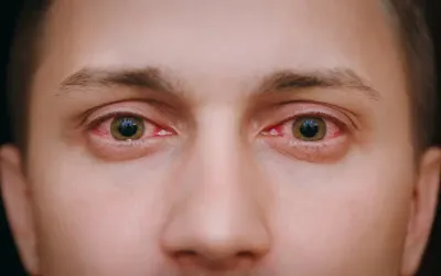 Red Eyes: Experts explain common causes and preventions