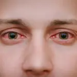 Red Eyes: Experts explain common causes and preventions