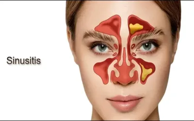 Sinus Infection (Sinusitis): Causes, Symptoms & Treatment