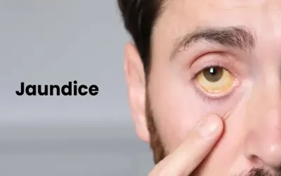 What is Jaundice? Symptoms, causes, treatment, prevention
