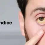 What is Jaundice? Symptoms, causes, treatment, prevention
