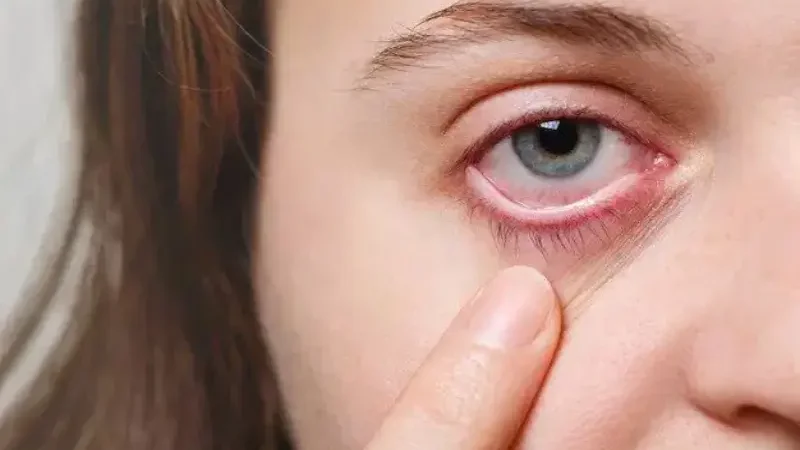 Dry eyes: Symptoms, causes, treatment, prevention