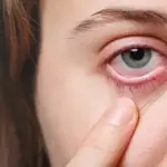 Dry eyes: Symptoms, causes, treatment, prevention