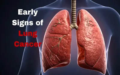 Five early signs of lung cancer
