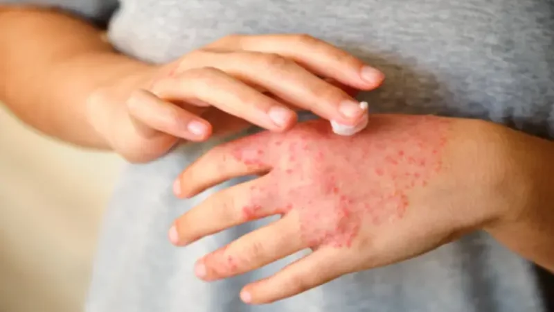 Here's everything you need to know about Eczema