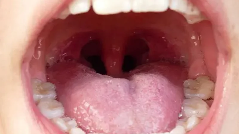 What are tonsil stones? Symptoms, causes, diagnosis, treatment, and prevention