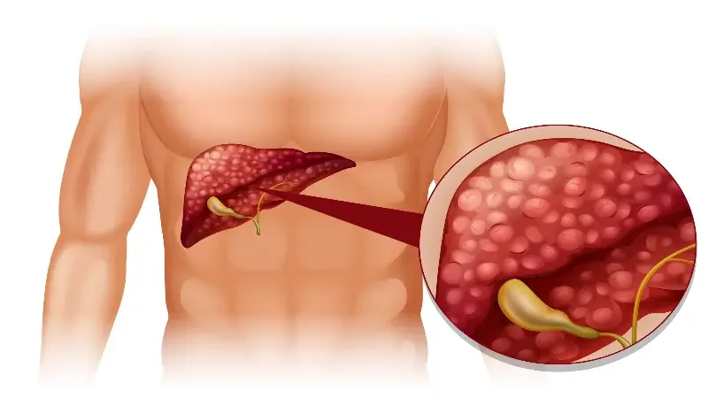 Gallbladder: Symptoms, causes, diagnosis, treatment, and prevention