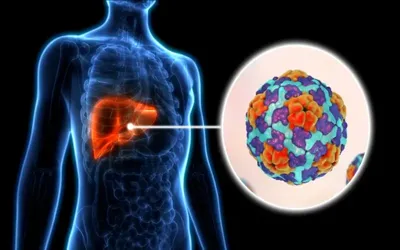Hepatitis A: Symptoms, causes, diagnosis, treatment, and prevention