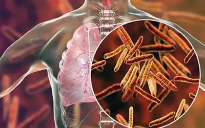 More than 93,000 children are affected by tuberculosis each year in Pakistan