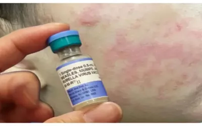 South Carolina Health Officials Warn of Growing Measles Outbreak
